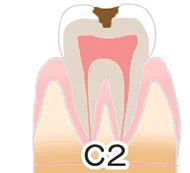 虫歯の進行段階と痛みの関係