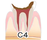 虫歯の進行段階と痛みの関係