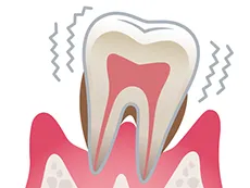 歯周病の進行段階と痛みの関係