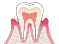歯周病の進行段階と痛みの関係
